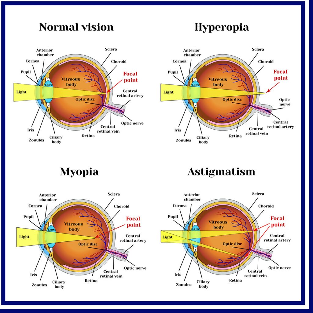 how many types of refractive errors